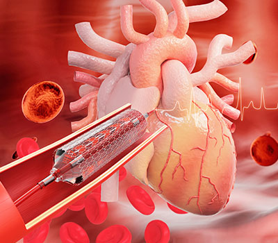 Image of Stent implantation for heart coronary with blood cell background.