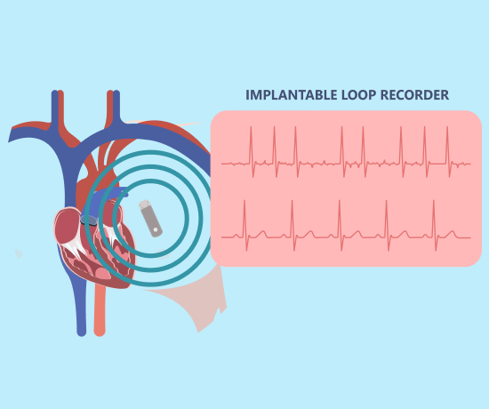 The image shows the working of an implanted Loop Recorder with its reading shown as signals.