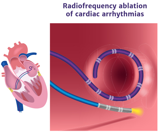 A vector illustration of the Radio frequency Ablation of cardiac Arrhythmia.