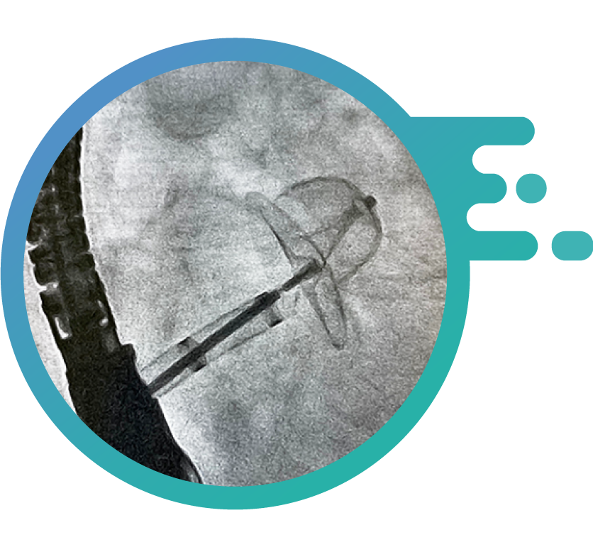 Image showing the insertion of a Cardiac Plug.
