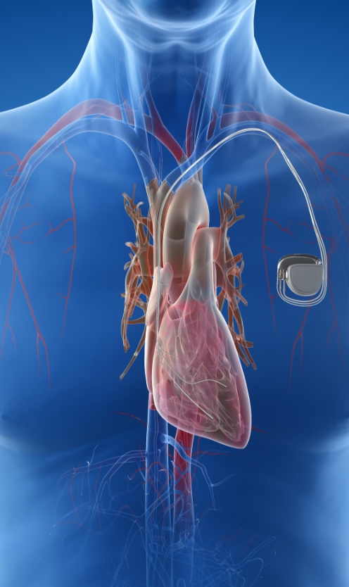 The image shows the device position after Defibrillator (AICD) Implantation.