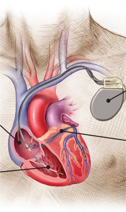 Image shows the Cardiac Resynchronization Therapy with the device and catheters.