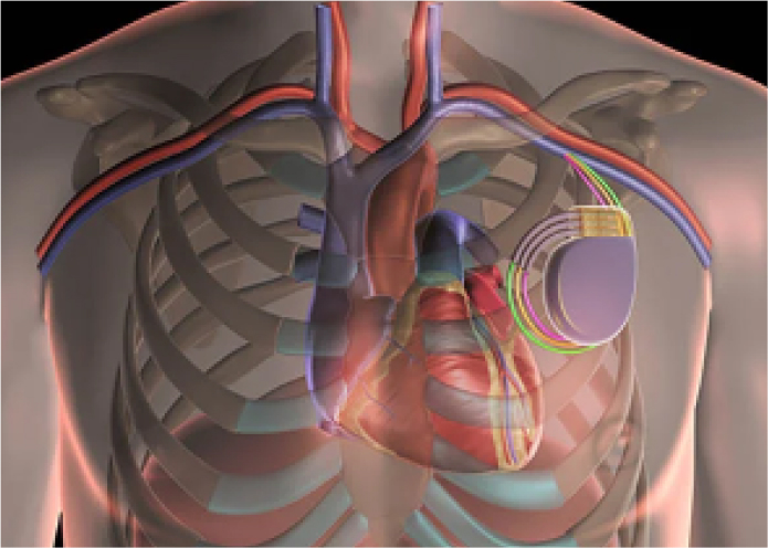 An illustration of Cardiac Resynchronization Therapy (CRT).