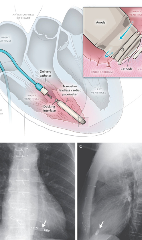 A collage image of Leadless Pacemaker Implantation and the X-rays showing the position of the pacemaker after implantation.
