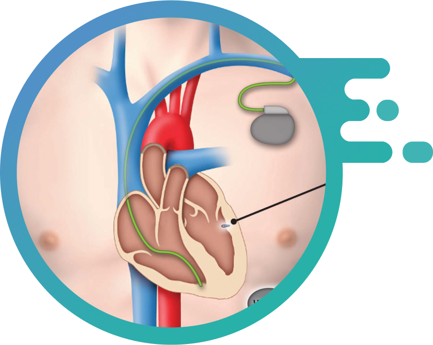A picture showing the Leadless Pacemaker Implantation procedure.