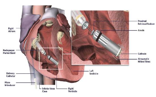 A picture showing the Leadless Pacemaker Implantation with labels.