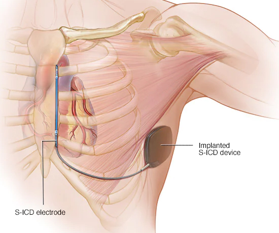 Image showing the implanted S-ICD device and S-ICD electrode.