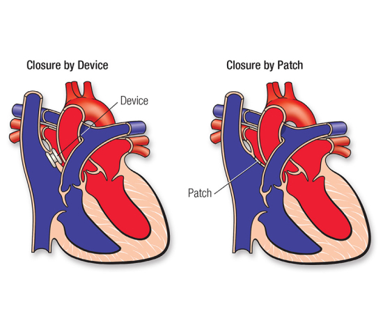 Image showing the Atrial Septal Defect (ASD) Device Closure by device and patch.