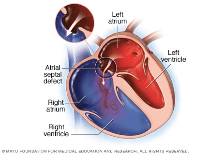 The image of the heart shows the Atrial septal defect.