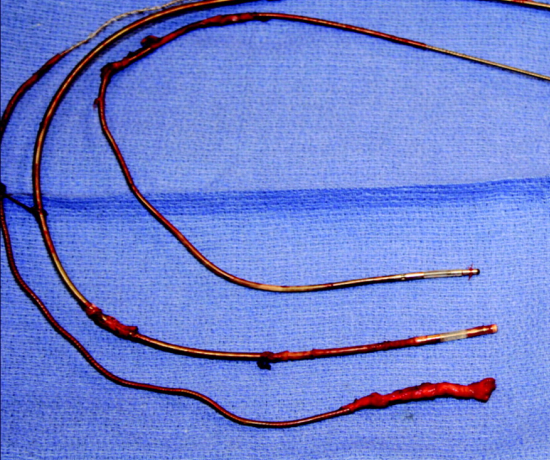 Wires used in the Pacemaker Lead Extraction procedure.
