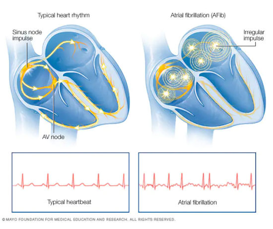 The image shows the  heartbeat and rhythm of a normal heart and a heart with