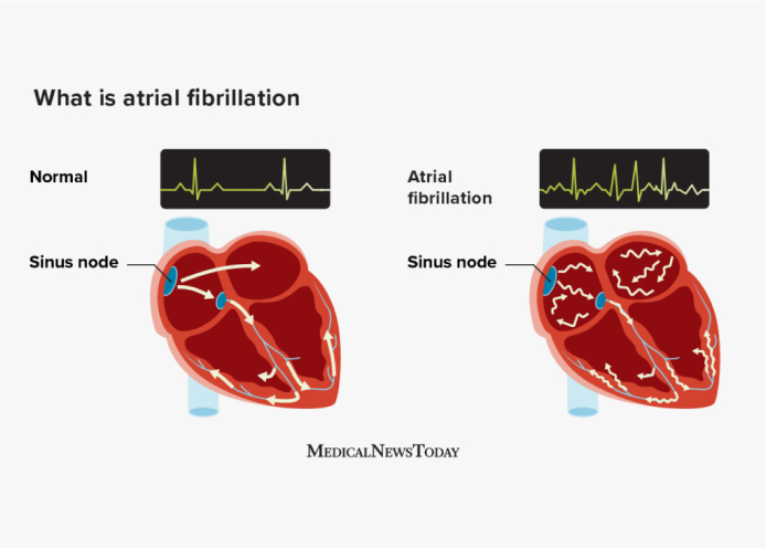 The image illustrates normal heart function and Atrial Fibrillation with graphs.