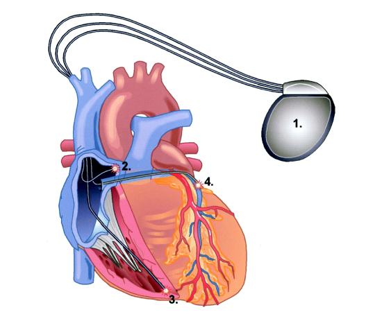 The image shows the placement of an artificial pacemaker in the heart.