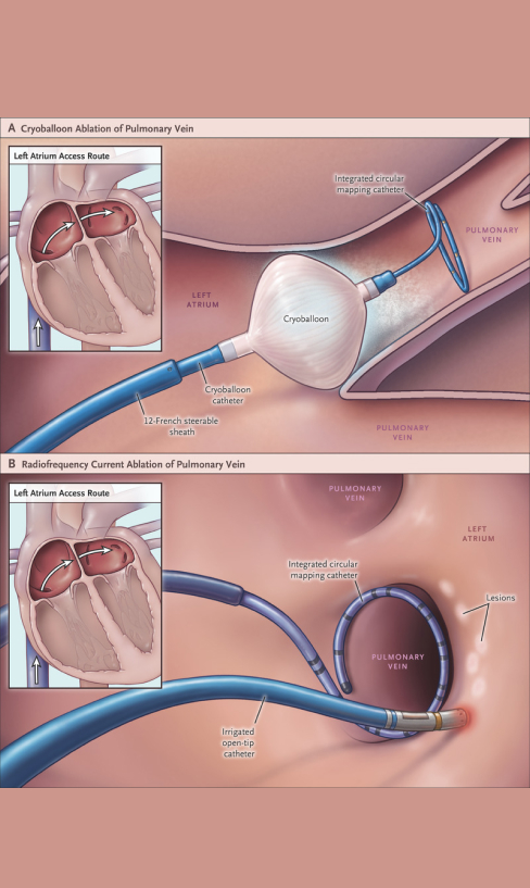 The image illustrates the Cryo Balloon Ablation procedure of the pulmonary vein.