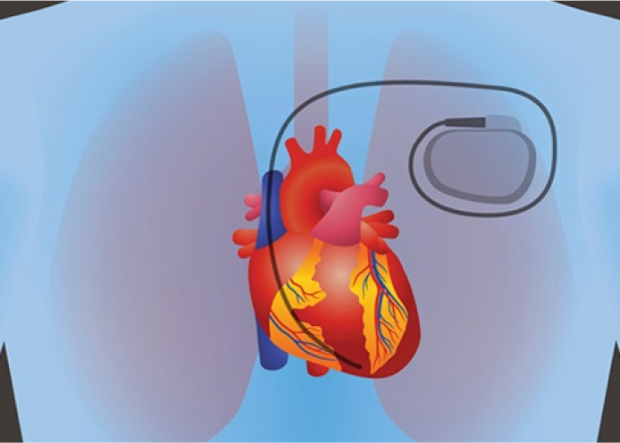 The image illustrates Defibrillator Implantation.