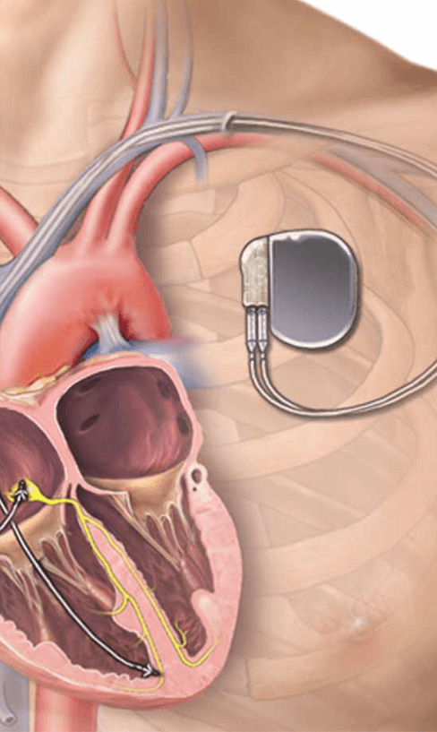 A vector illustration of an implanted pacemaker.