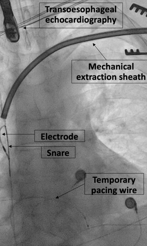 Image during the Pacemaker and Defibrillator Lead Extraction. The elements seen are labelled.