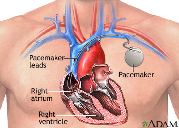 A vector illustration of an implanted pacemaker with catheters.