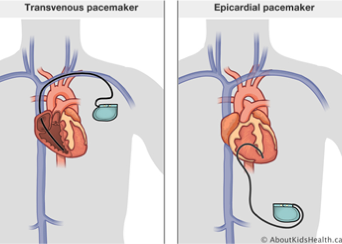 The image illustrates the Transvenous and Epicardial pacemaker.