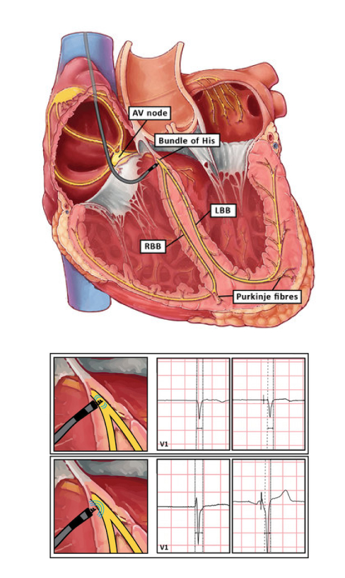 The image illustrates the heart's Conduction System Pacing with graphs.