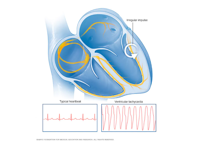 Image illustration of Ventricular Tachycardia compared to a normal heart with their signals.