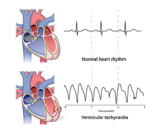 The image compares the normal heart rhythm with Ventricular Tachycardia.
