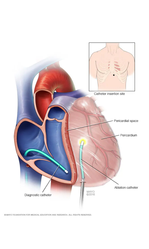 Image illustration of Ventricular Tachycardia (VT) Ablation procedure.
