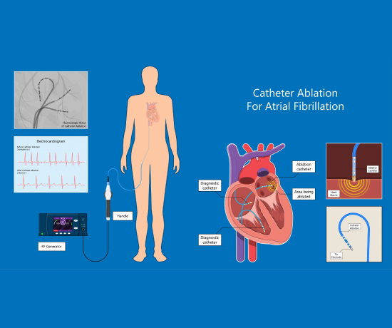 A clear illustration of catheter ablation for Atrial Fibrillation.