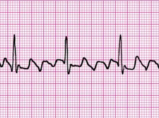 The image of an ECG graph.
