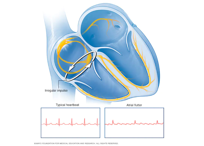 An illustration of a heart with an Atrial Flutter problem is explained with pulse signals of a typical heartbeat and with Atrial Flutter.