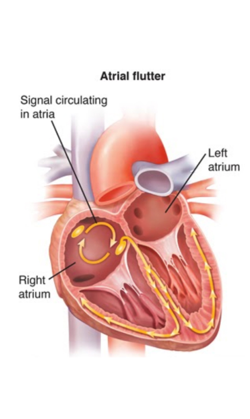 The image illustrates the Atrial Flutter Ablation.