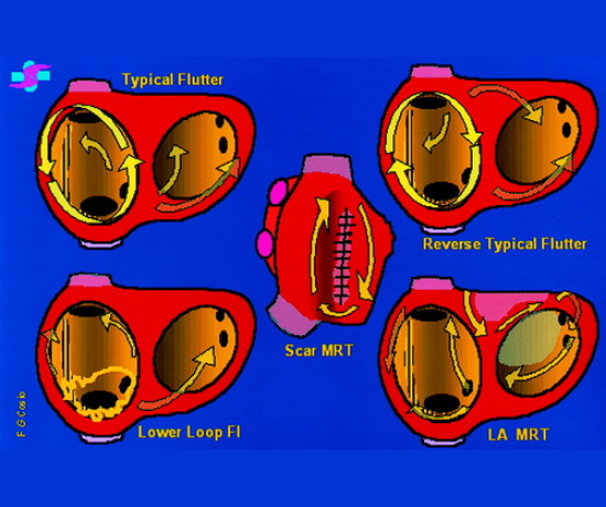 The image shows different Cardiac ablation in Treating a Spectrum of Arrhythmias.