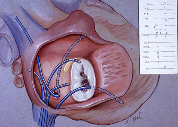 An image illustration of Electrophysiology Study.