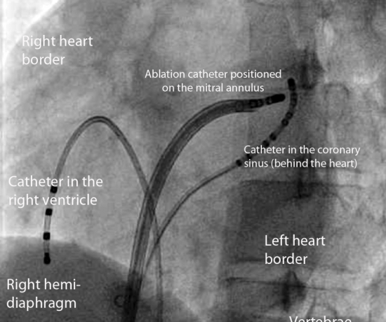 Image sowing the catheters inside the heart.
