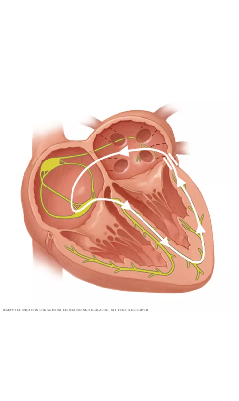 A bisection image of the heart illustrating Paroxysmal Supraventricular Tachycardia.