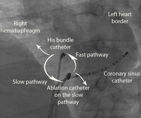 Image of the His bundle catheter and the Ablation catheter.